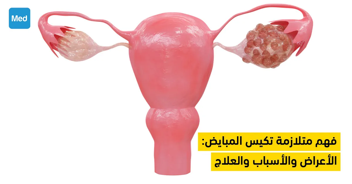 فهم متلازمة تكيس المبايض: الأعراض والأسباب والعلاج